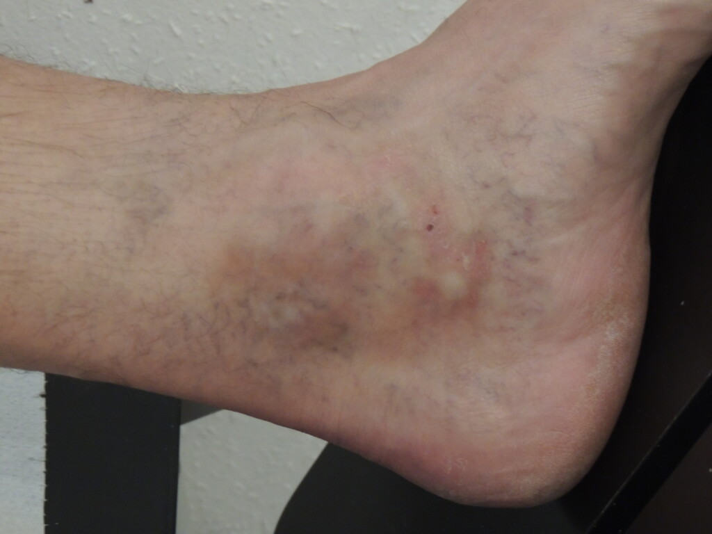 CVICoronaphleb.-Atrophieblanche