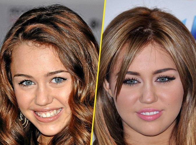 Miley-Cyrus-avant-apres-une-chirurgie-des-levres_portrait_w674