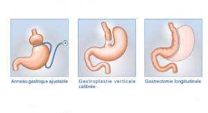 chirurgie-obesite-techniques